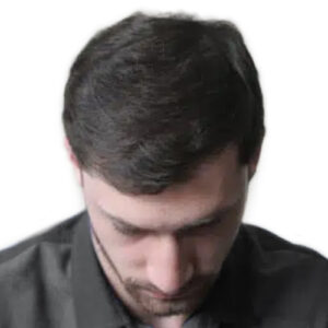 hair transplant cost Leicester