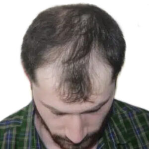 hair transplant England price