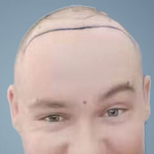hair transplant England cost