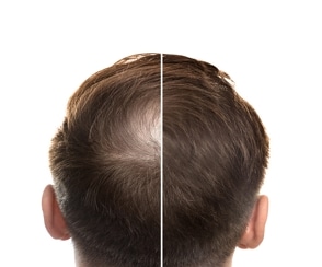DHI Hair Transplant 2