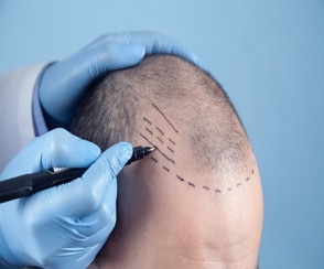 DHI Hair Transplant Liverpool