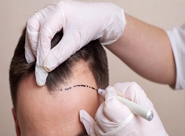 FUE Hair Transplant Liverpool