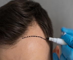FUE Hair Transplant