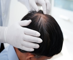 Male Hair Loss Treatment