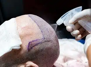 FUE Hair Transplant Liverpool