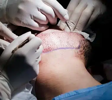 beard transplant liverpool