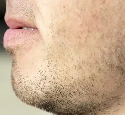 beard transplant surgery