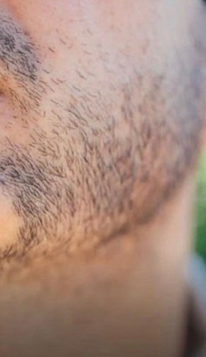 beard transplant uk