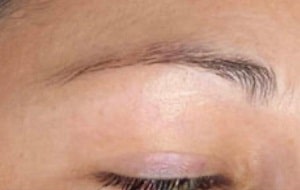 eyebrow hair transplant liverpool