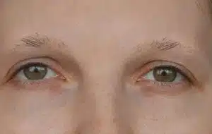 eyebrow transplant cost liverpool