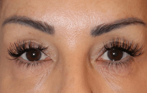 eyebrow transplant cost
