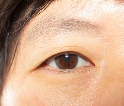 eyebrow restoration
