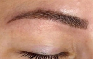 eyebrow transplant uk