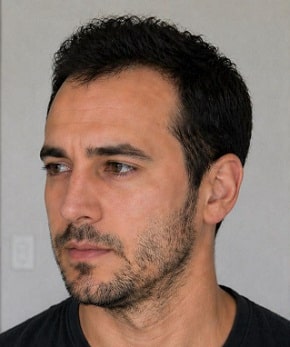 facial hair transplant liverpool