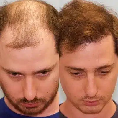 hair transplant clinic liverpool