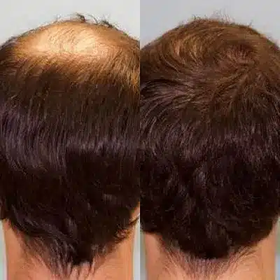 hair transplant results