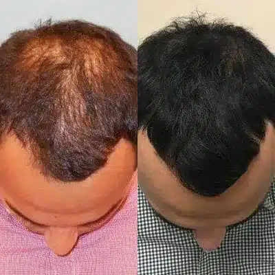 hair transplants liverpool