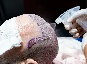 fue hair transplant liverpool