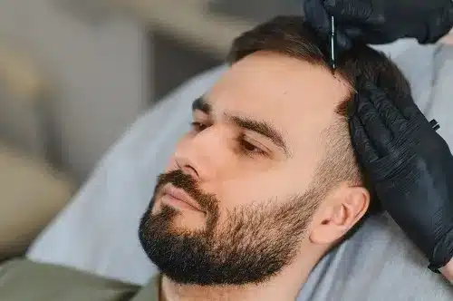 hair transplant loverpool