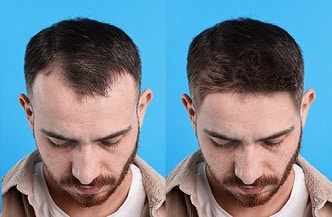 Hair Transplant Liverpool