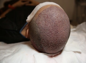 Hair Transplant