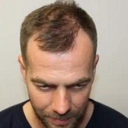 direct hair implantation
