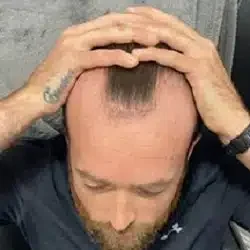 hair transplants liverpool before image