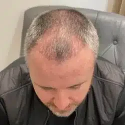 hair transplants liverpool before image