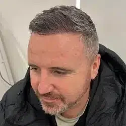 hair transplants liverpool after image